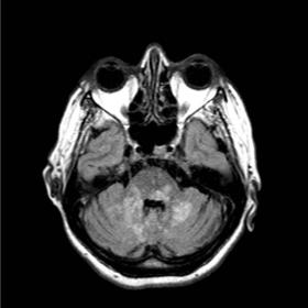 Brain MRI on admission. Axial FLAIR and T2-weighted images showed multiple coalescing hyperintense lesions in the pons, the c