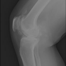 A lateral radiograph of the knee shows degenerative changes & multiple intraarticular chondral bodies, few of which show ‘r