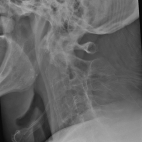 Lateral radiograph of the cervical spine. Levels C5-C7 are not entirely visible due to the superimposition of the shoulders. 