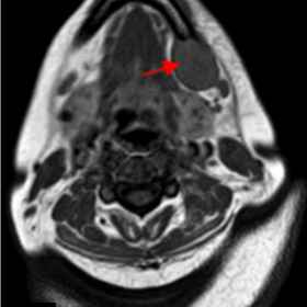 Magnetic Resonance Imaging (MRI) Turbo Spin Echo (TSE) images through the mandible. Axial T1 weighted TSE image showing the e