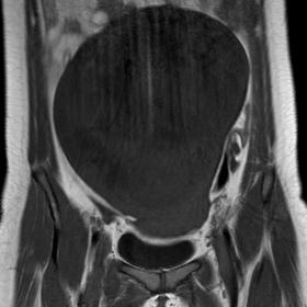 T1W Magnetic resonance imaging (MRI) image  shows a large well defined hypointense abdomino-pelvic lesion.