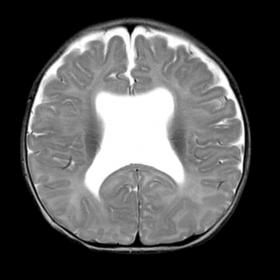 Axial T2W MRI image shows absent septum pellucidum with box shaped configuration of bilateral lateral ventricles.