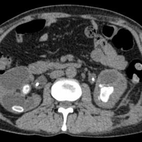 Axial Plain CT section through the mid pole of kidneys showing calcified lesions in bilateral kidneys with grossly dilated co