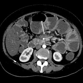 Arterial phase contrast enhanced CT. A fibro-fatty mass with poorly defined borders is seen within the mesenteric root (arrow