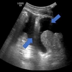 US exam depicted moderate quantity of free fluid in the abdominal cavity displacing the hollow structures.
