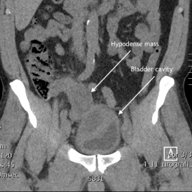 NCCT- scan shows a large hypodense mass in the right side of the pelvis in direct contact with the bladder.