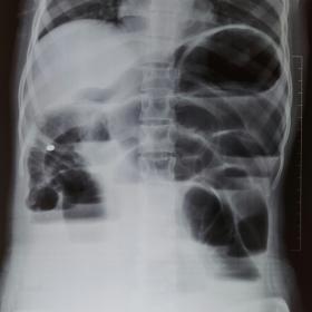 Abdominal x-ray, erect view showing  dilated small bowel loops with multiple air-fluid levels.
