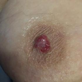 Picture of right breast shows nipple erosion with red granulation surface and some exudate. Areolar and breast skin are norma
