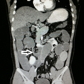 Computed Tomography of abdomen, coronal section showing a transition zone (white arrow) with abrupt narrowing of distal ileal