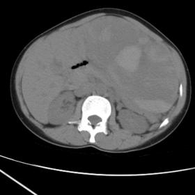 Plain axial CT section of abdomen revealed a large well defined soft tissue density lesion with hyperdense areas within invol