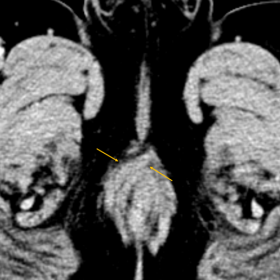 A trans sphincteric peripherally enhancing collection (Figure 1) with supra levator extension (Figure 2) is seen on the right