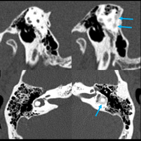 Temporal bone CT scan demonstrating increased density within the left semicircular canals (arrows), comparing to the right si