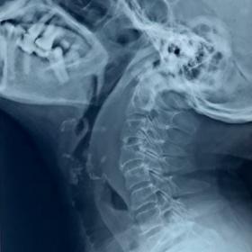 Cervical x ray lateral view showing prevertebral soft tissue widening.