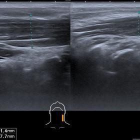 Ultrasound image of contracted sternocleidomastoid muscle (up to 11 mm on the left and up to 8 mm on the right side).