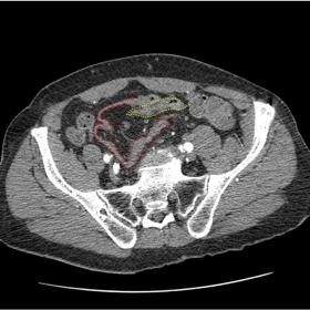 Axial contrast-enhanced CT image shows telescoping of medial portion of sigmoid colon (yellow dots) into distal sigmoid colon