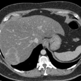 Axial portal venous phase CT - enhancing lesion in segment 7 of the liver with a rim of high attenuation and subtle calcifica
