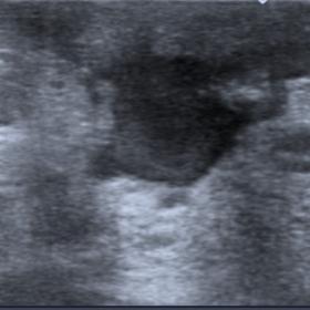 Ultrasound reveals a retro-areolar hypoechogenic lesion with thick liquid content and thickening of the areolar skin, suggest