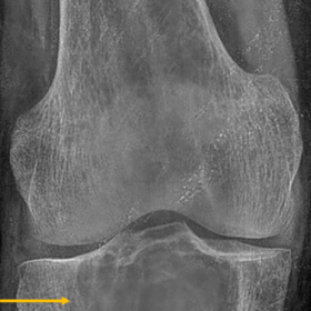A well-defined, multilocular, lytic lesion (arrows) in the proximal tibial epiphysis and metaphysis with subarticular extensi