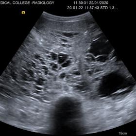 Ultrasound image shows a multiloculated cystic lesion in retroperitoneal compartment.