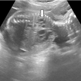 On ultrasound gray scale images, multiple variable sized intercommunicating anechoic cystic lesions are noted involving right