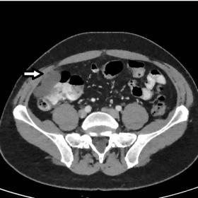 CT-scan showed a poly-lobulated hypodense lesion with moderate peripheral contrast uptake and minimal adjacent fat stranding.