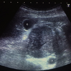 Ultrasound B-mode image shows a hypoechogenic retroperitoneal mass, with a central anechoic area suggestive of necrosis. The 