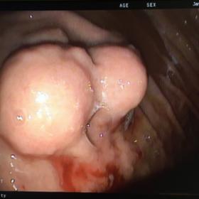Endoscopic image showing a bilobed gastric schwannoma at the gastric fundus.