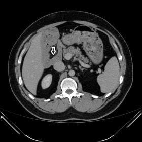 Mid abdomen  CT demonstrated the third part of the duodenum was deviated to the right of spine