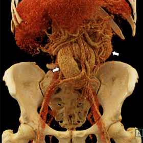 3D virtual reconstructed image of a CECT abdomen demonstrates multiple tortuous and dilated mesenteric veins in the upper abd