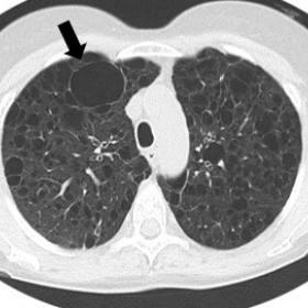 Unenhanced chest CT.  Bilateral diffuse LAM. The largest cyst is subpleural, and is located in the apical segment of the righ