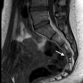 Sagittal T1W and T2W (figures 2a and 2c), and oblique coronal T1W and T2W (figures 2b and 2d) Dixon images of the pelvis show cancellous bone marrow edema (white asterisk) associated with the fracture previously described (white arrows). Discrete sacral canal stenosis is noticed.