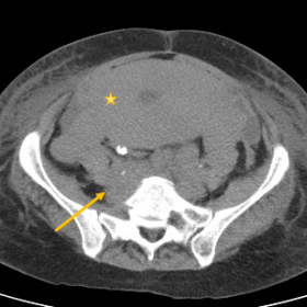 Abdominopelvic non-enhanced CT scan. Diffuse uterus enlargement (star) with multiple retroaortic adenopathies (arrow and circ