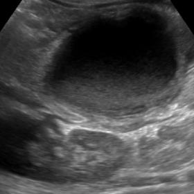 A large thick-walled retroperitoneal cyst with internal echoes.