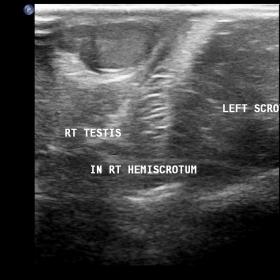 Empty left hemi-scrotum with a normal right testis.