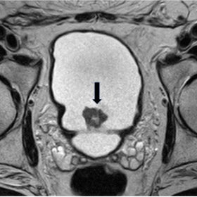 Axial T2-weighted MR image shows a tumor on the trigone bladder wall (black arrow).