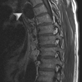 MRI of the spine shows an ovoid paravertebral mass (arrowhead), adjacent to the thoracic aorta. The mass has a thin wall and 