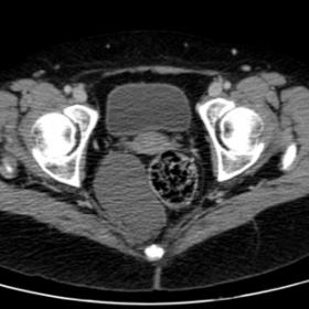 Axial CT image with intravenous contrast, showing a homogeneus hypodense lesion at right retrorectal space, posterior to uter