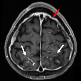 Post-gadolinium T1 images demonstrating diffuse pachymeningeal thickening and enhancement (red arrow), as well as leptomening