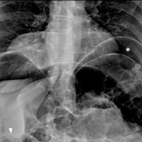 Radiograph in PA (A) and LL (B) projection _ Sub-diaphragmatic free air (asterisks) and distension of the abdominal viscera (
