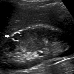 (a) Ultrasound shows a well-circumscribed cortical lesion with a hyperechogenic wall in the upper pole of the right kidney. (