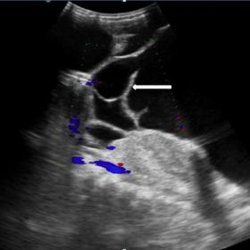 Ultrasonography image shows multiple septations within an intra abdominal cystic lesion. There is no internal vascularity see