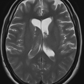 Axial T2W (A)& FLAIR (B) MR images of the brain reveals intraventricular bleed into the bilateral lateral ventricles and suba