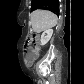 Sagittal contrast-enhanced CT showing combination of cecal mass and radiopaque lesion causing partial SBO
