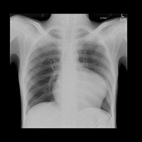 Chest radiograph showing abnormally prominent and bulging left heart border