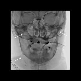 Plain film showed the guidewire’s intracranial position (arrows)