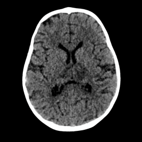 CT images show hypodensities in bilateral thalamus