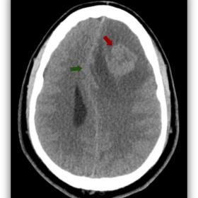 Axial CT image demonstrating heterogeneous and slightly hyperdense left frontal lesion (red arrow), which causes brain midlin