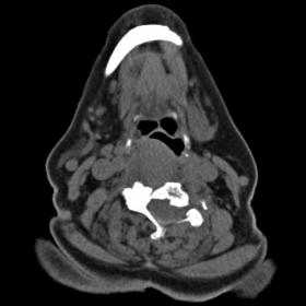 Axial CT scan image before contrast media injection: there is a large iso-hypodense lesion impressing the right posterolatera