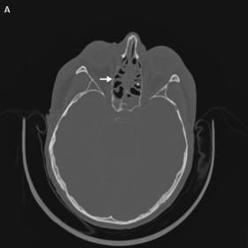 Axial view of non-contrasted head CT. Diffuse paranasal sinusitis