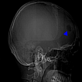 CT skull lateral projection scout image showing  a well defined oval-shaped, lytic lesion (blue arrow) involving the right fr